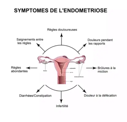 Symptome de l'endometriose